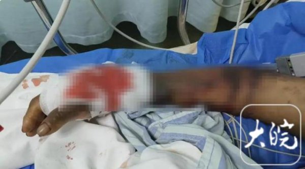 鸿满仓 四川广汉一老人被蛇咬伤后引发“毒蛇跑失”等不实言论 主管部门辟谣：谣言中的蛇场已于近日搬离